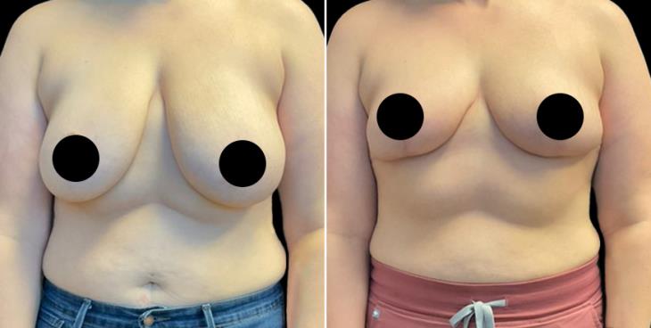 Cumming Georgia Reduced Breasts Front View