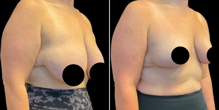 Georgia Reduced Breast Size 