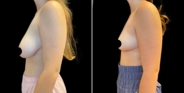 Reduced Breast Size Marietta 
