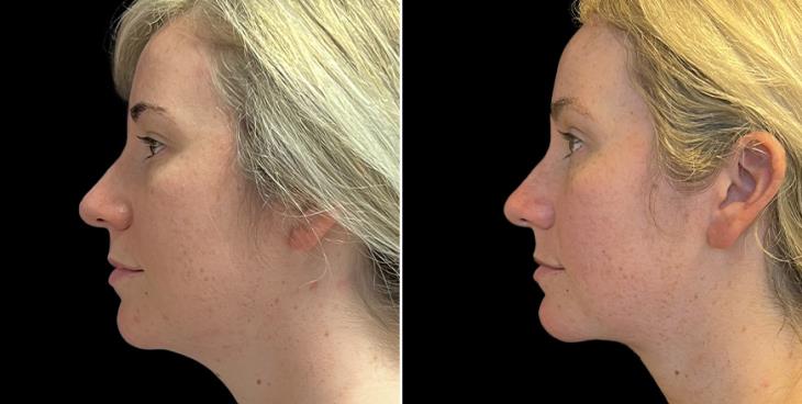 GA Facial Lipo & Chin Implant Results