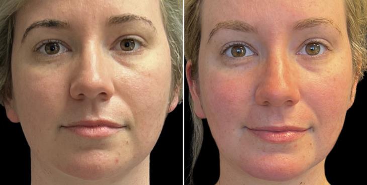 Chin Implant & Facial Lipo Results