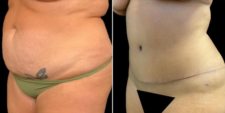 Tummy Tuck Results Side View