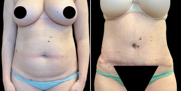 Georgia Abdominoplasty Surgery Before & After