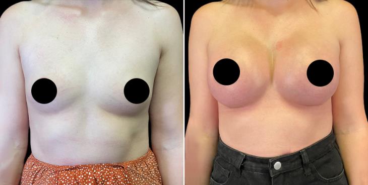 Full Profile Breast Augmentation