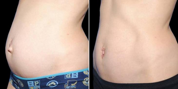 Atlanta Lipo Before And After