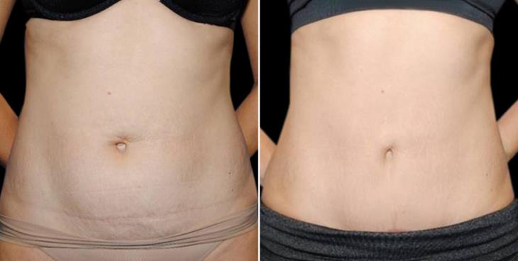 Liposuction Results