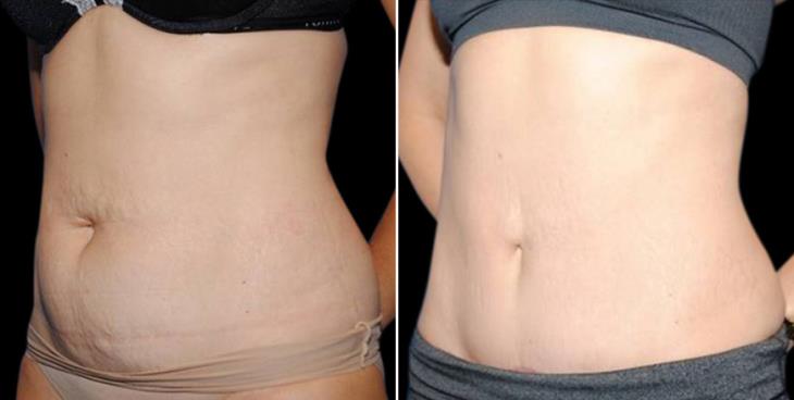 Liposuction Results Side View