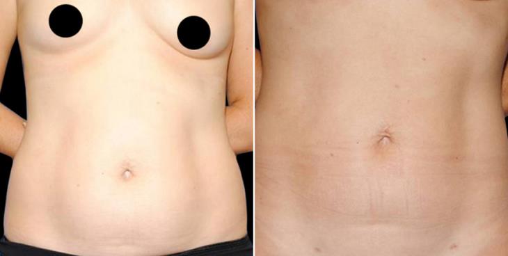 Liposuction Results Atlanta