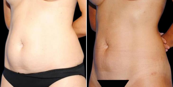 Liposuction Results Atlanta Side View