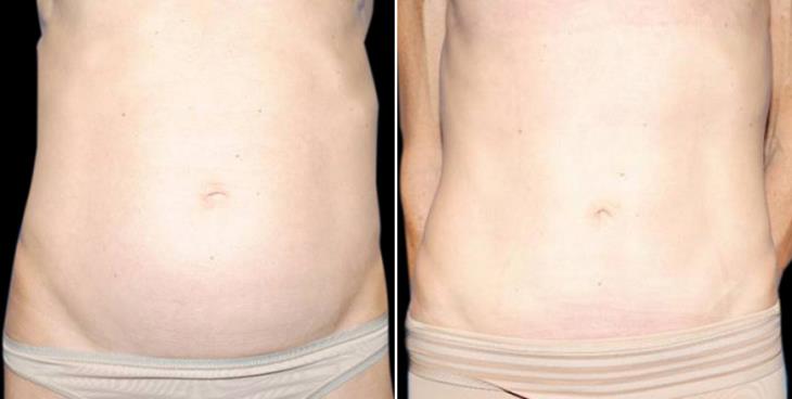 Before And After Lipo Atlanta