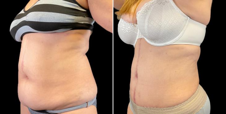 Tummy Tuck Results ¾ View GA