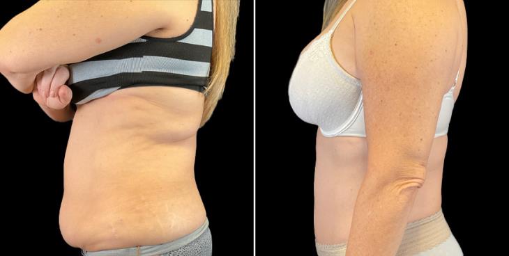 Tummy Tuck Results Side View GA