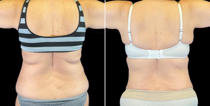 GA Tummy Tuck Results