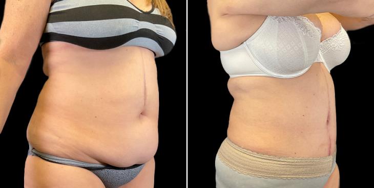 GA Tummy Tuck Results ¾ View