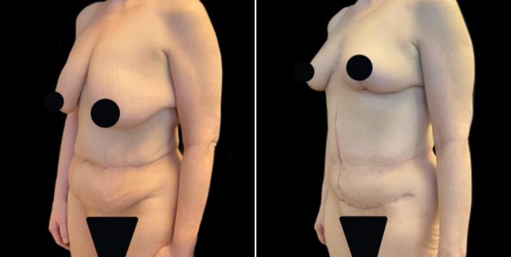 Abdominoplasty Surgery GA