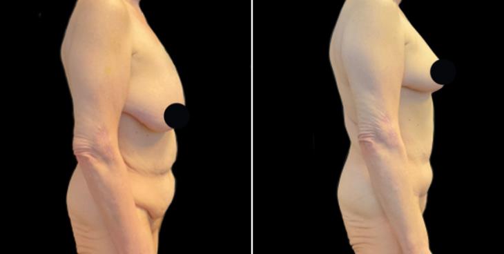 Abdominoplasty Surgery Marietta