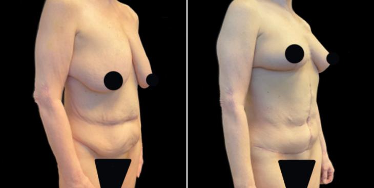 GA Abdominoplasty Surgery