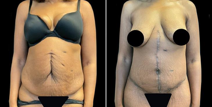 Cumming GA Abdominoplasty Surgery