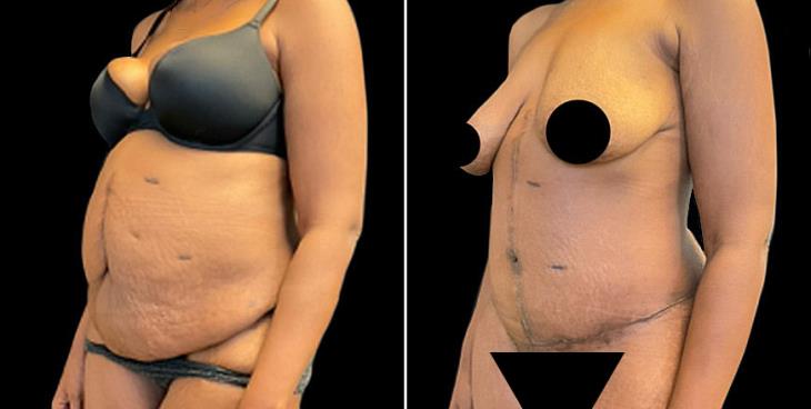 Abdominoplasty Surgery Marietta Georgia