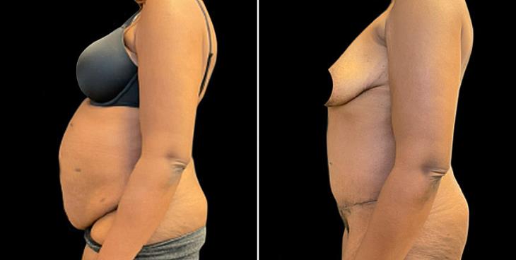 Abdominoplasty Surgery Cumming Georgia