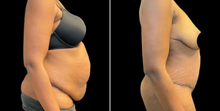 Cumming Georgia Abdominoplasty Surgery