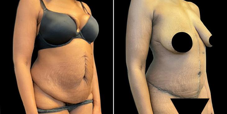Marietta GA Abdominoplasty Surgery