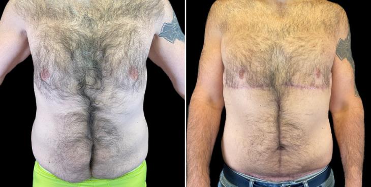 Male Tummy Tuck