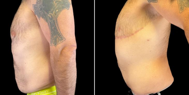 Male Tummy Tuck Results