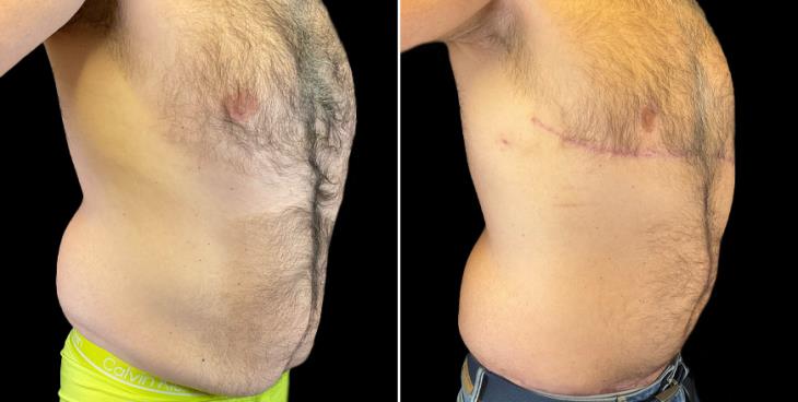 Male Tummy Tuck Before & After