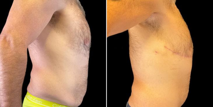 Before & After Male Tummy Tuck