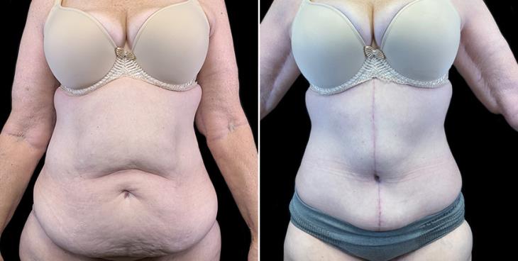 Before & After Stomach Tuck Surgery Atlanta Georgia Front View