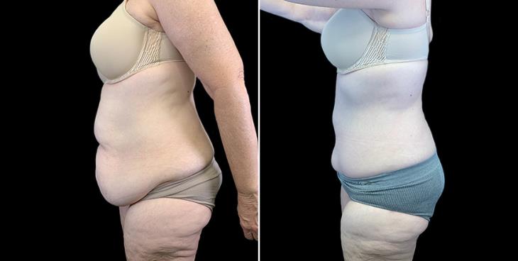 Before & After Stomach Tuck Surgery Atlanta Georgia Side View