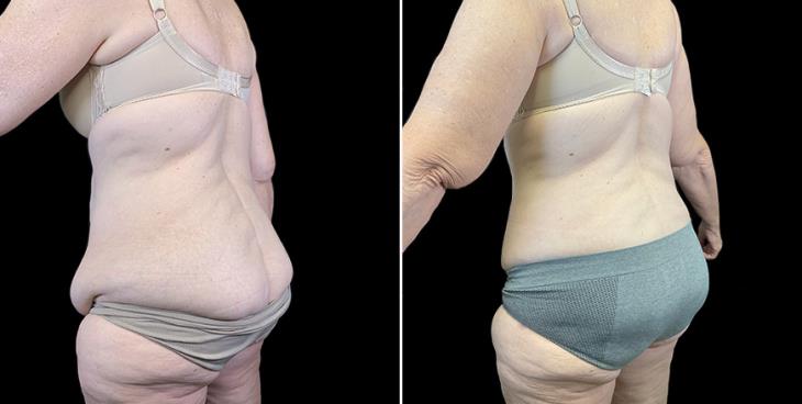Before & After Stomach Tuck Surgery Atlanta Georgia ¾ Back View