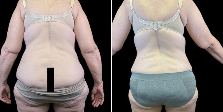 Before & After Stomach Tuck Surgery Atlanta Georgia