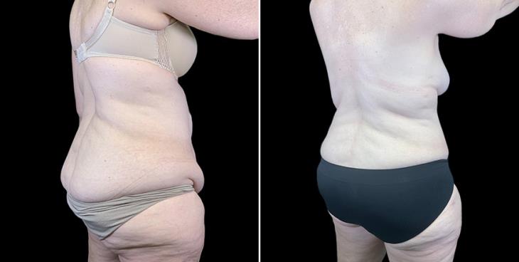 ¾ Back View Before & After Stomach Tuck Surgery Atlanta Georgia