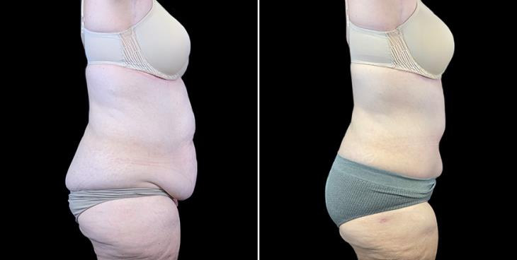 Side View Before & After Stomach Tuck Surgery Atlanta Georgia