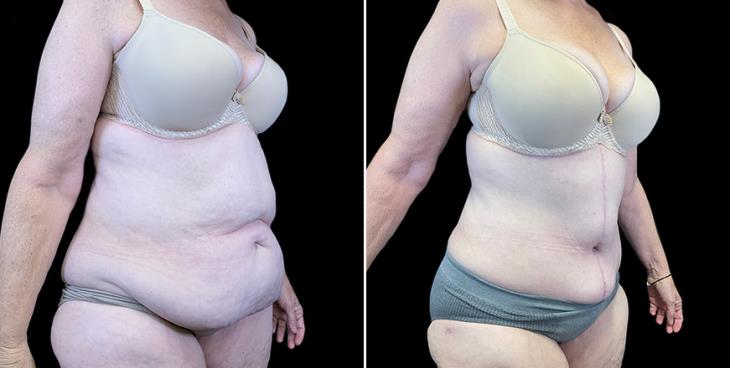 Before & After Stomach Tuck Surgery Atlanta Georgia ¾ View