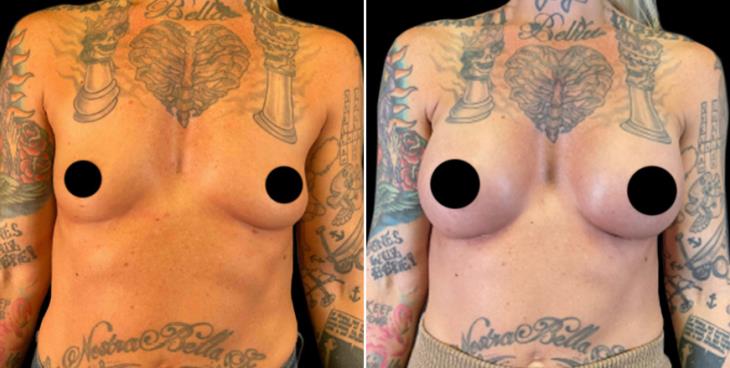 Breast Implant Results Marietta GA