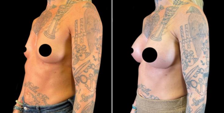 Marietta GA Breast Implant Results