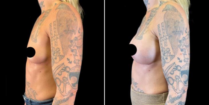 Breast Implant Results Marietta Georgia