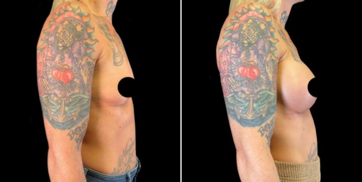 Marietta Georgia Breast Implant Results Side View