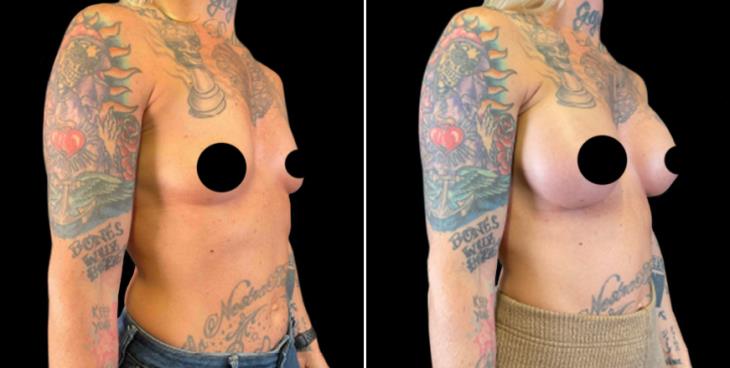 Marietta Georgia Breast Implant Results