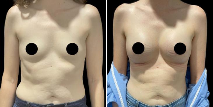 Marietta Georgia Breast Implant Results Front View