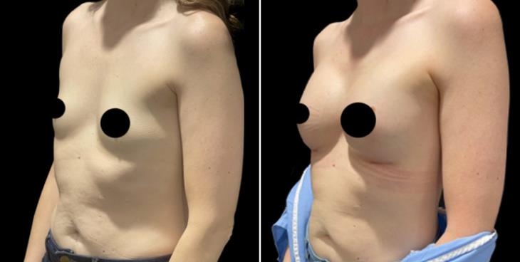 Marietta Georgia Breast Implant Results ¾ View 