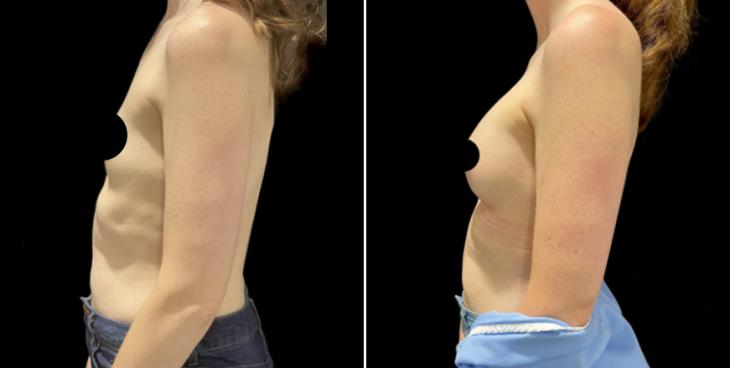 Before & After Breast Augmentation Marietta