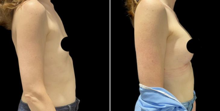 Before And After Breast Augmentation Marietta