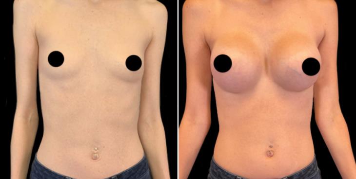 Marietta Before And After Breast Augmentation