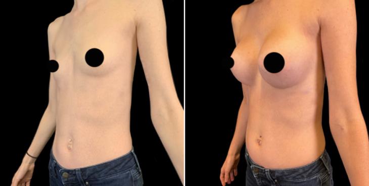 Before & After Breast Implants Marietta