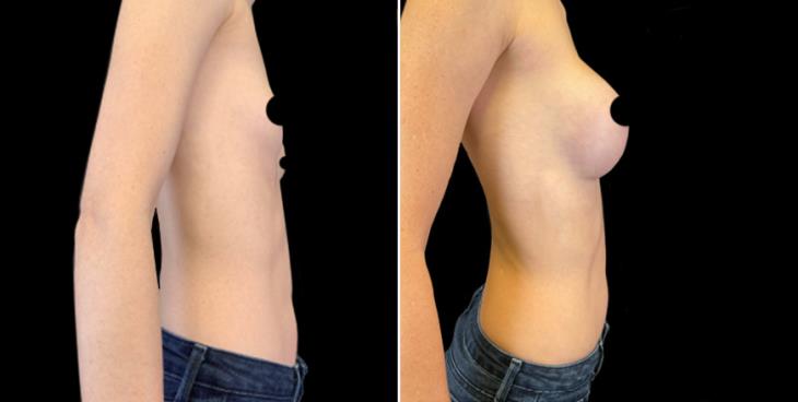 Marietta Breast Implants Before And After