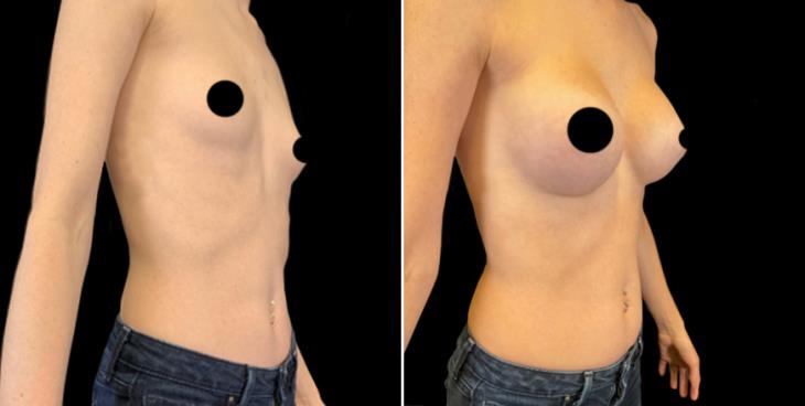 Before And After Breast Implants Marietta